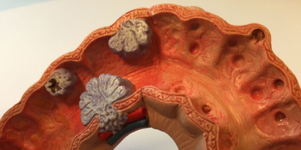 εκκολπωματίτιδα