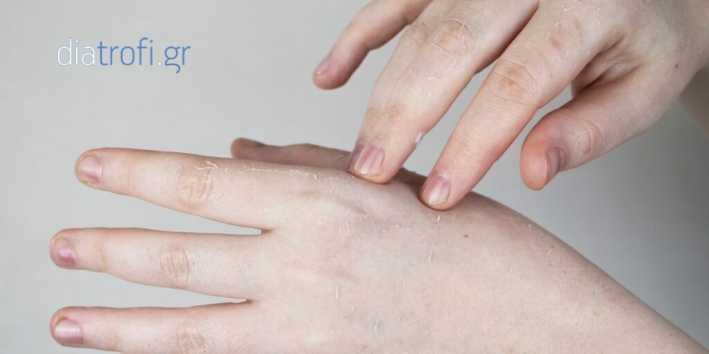 Μυκητίαση και Διατροφή