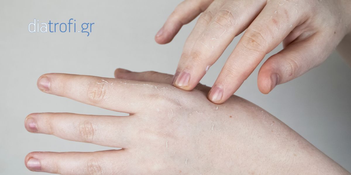 Μυκητίαση και Διατροφή